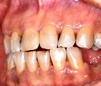 Gum Disease prevention tips from Philadelphia